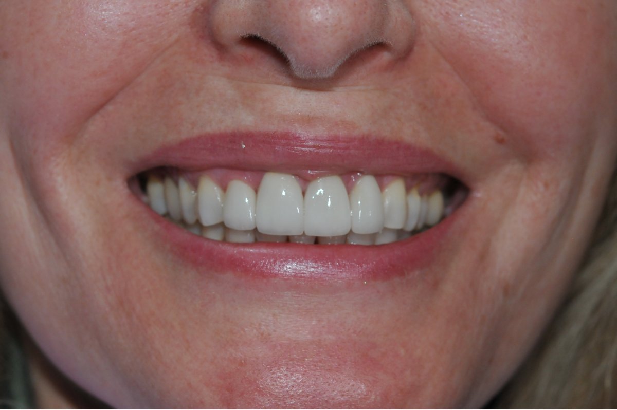 Before and after smiles at Alleman Family Dental Boulder, CO